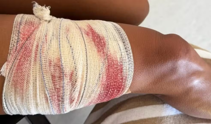 A advogada foi mordida por um tubarão-lixa durante um mergulho em Fernando de Noronha. - Imagem: Reprodução/Instagram/@taydalazen